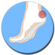 Achilles Tendinitis