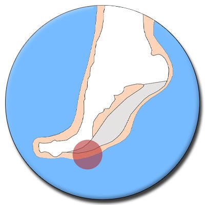 Morton's Neuroma - The Insole Store