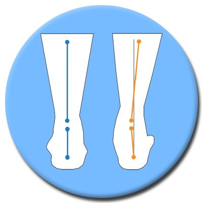 Overpronation - The Insole Store